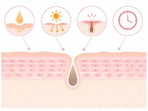 Cross-section of skin with a central pore and four insets showing oil secretion, sun exposure, a clogged pore, and a clock indicating time.