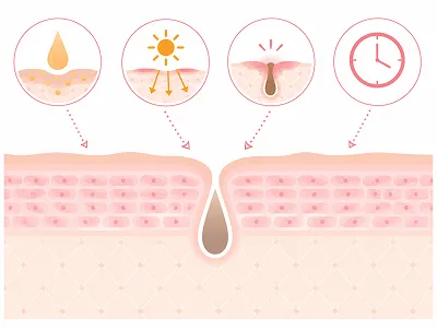 Cross-section of skin with a central pore and four insets showing oil secretion, sun exposure, a clogged pore, and a clock indicating time.