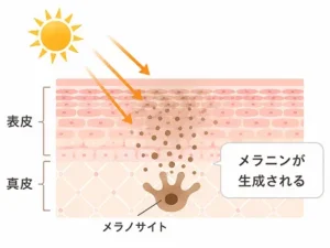 UV rays trigger melanin production by a melanocyte in the epidermis; melanin darkens surrounding skin cells (epidermis/dermis).