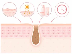 Cross-section of skin showing a pore with a hair follicle and a clogged center; icons above depict sun exposure, sunscreen application, skincare products, and a clock indicating time.