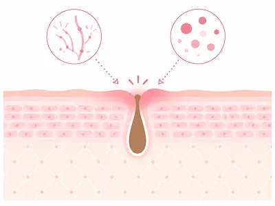 Cross-section of skin showing a hair follicle opening with magnified views of surrounding blood vessels and skin cells (insets).