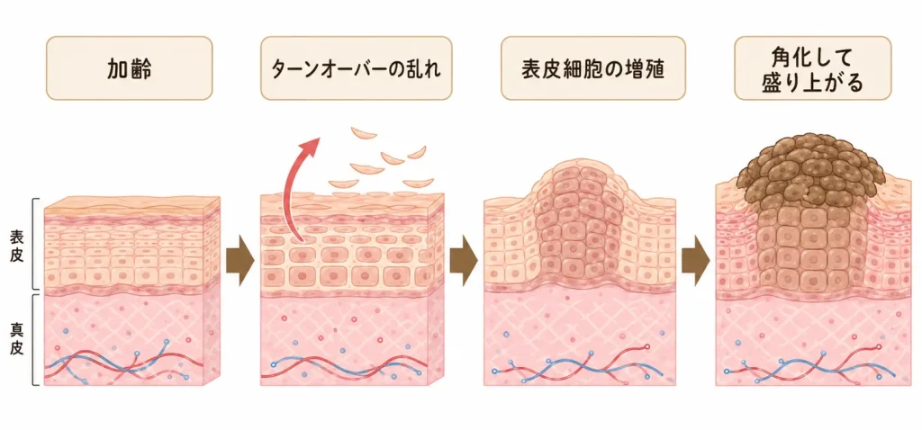 Diagram showing skin aging: disrupted epidermal turnover with increased epidermal cell proliferation forming a raised keratinized bump on the surface.