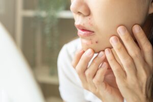Close-up of a person touching their chin with pimples on the cheek and chin area, indicating acne.