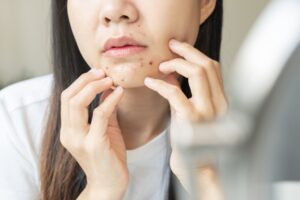 Young woman examining acne on her chin and cheeks in front of a mirror.