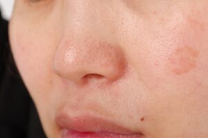 Close-up of a human nose and surrounding cheek with visible pores and light skin texture.