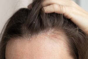 Close-up of a person lifting their hair to reveal the scalp with small white dandruff flakes along the hairline.