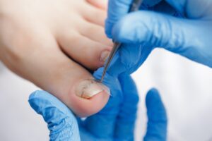 青い手袋をはめた足病医が、巻き爪の治療中に足の親指の爪に装着した装具を調整している。