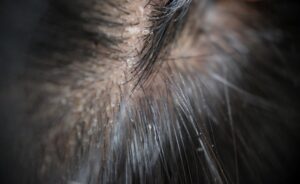 Close-up of a scalp with flaky dandruff among dark hair.