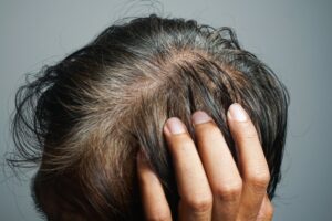 Hand lifting hair to reveal thinning scalp at the crown on top of the head