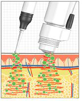 Close-up of a cosmetic device with needle tips applying treatment to skin, penetrating the outer layer and reaching underlying tissue.