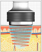 Cross-sectional diagram of an injection device delivering into skin, showing skin layers (epidermis, dermis) and a needle tip.