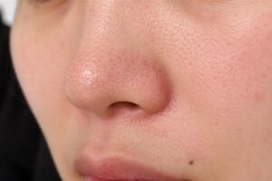 Close-up of a person's nose with visible facial pores and smooth skin around it.
