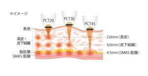 Cross-section of skin showing three treatment beams labeled PCT20, PCT30, and PCT45 delivering energy into epidermis, dermis, and SMAS layers at depths of 2.0mm, 3.0mm, and 4.5mm respectively (Japanese labels shown).